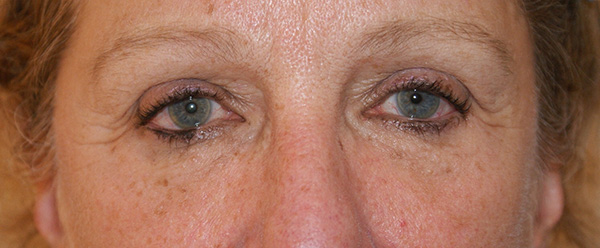 Photo of Patient 08 After Brow & Eyes Procedure