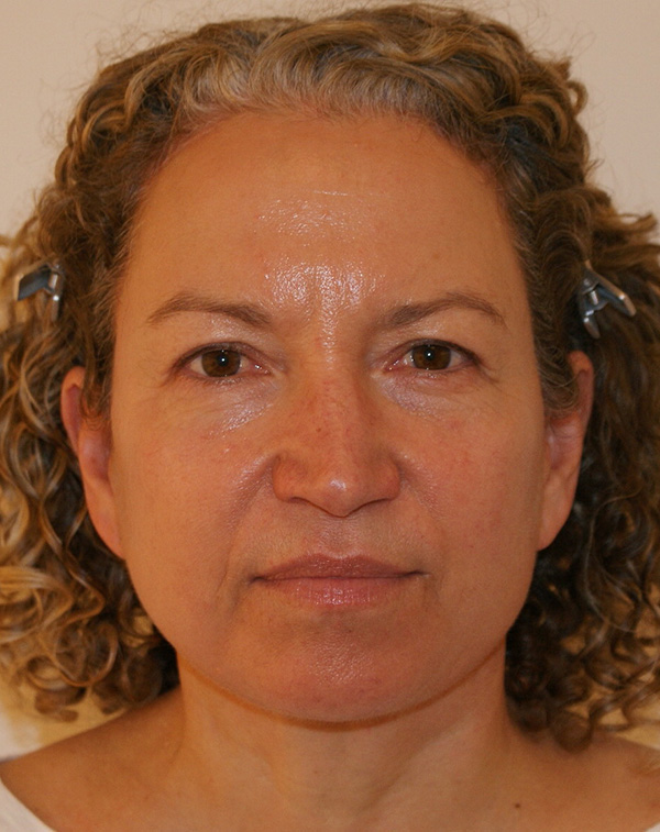 Photo of Patient 05 After Facial Fat Transfer Procedure