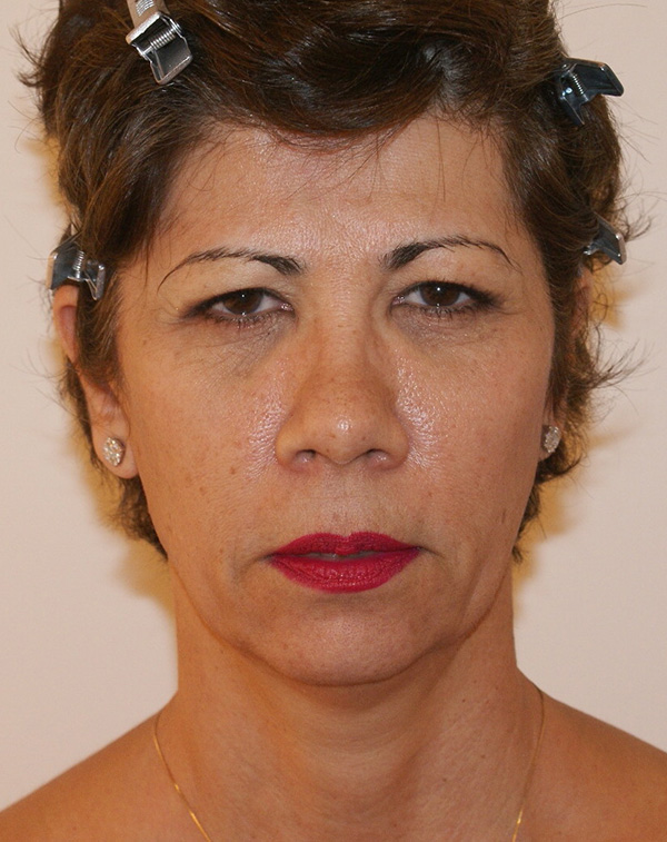 Photo of Patient 07 Before Facial Fat Transfer Procedure