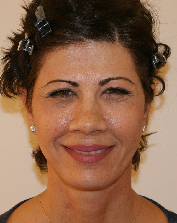 Photo of Patient 07 After Facial Fat Transfer Procedure