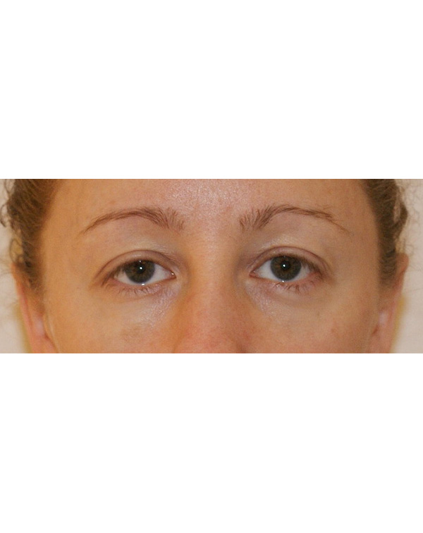 Photo of Patient 12 After Facial Fat Transfer Procedure