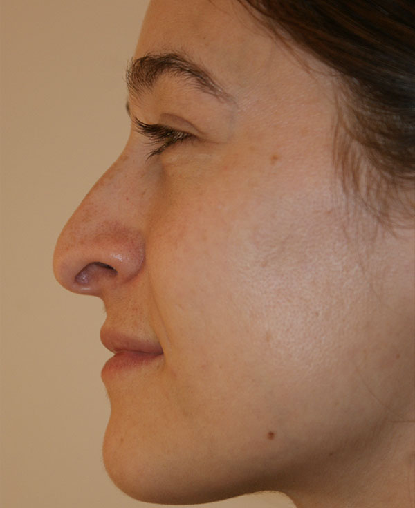 Photo of Patient 09 Before Nose Procedure