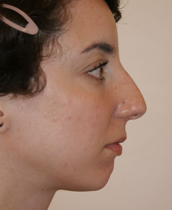 Photo of Patient 01 Before Chin Implants Procedure