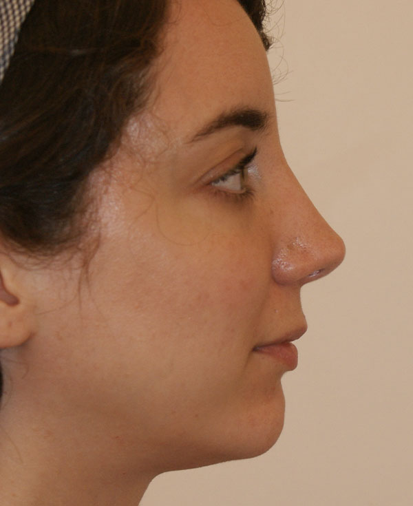 Photo of Patient 01 After Chin Implants Procedure