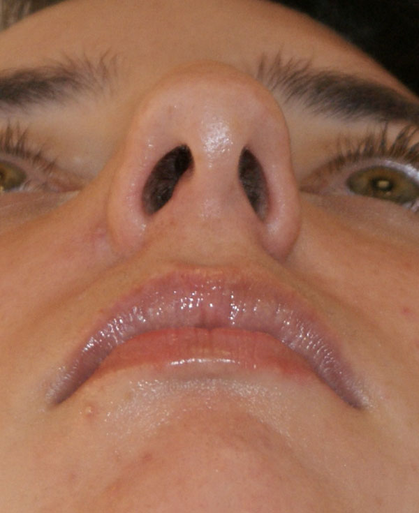 Photo of Patient 01 Before Chin Implants Procedure