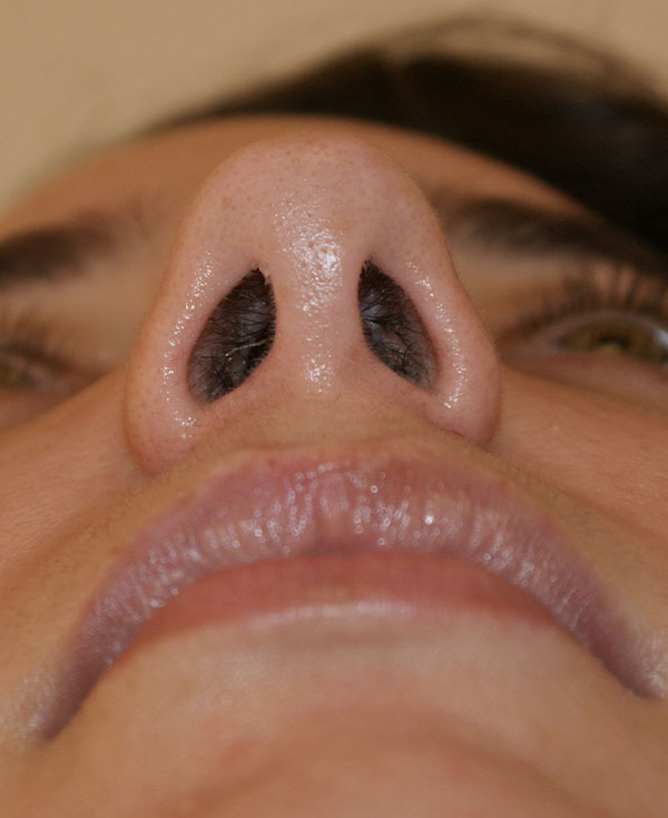 Photo of Patient 01 After Chin Implants Procedure