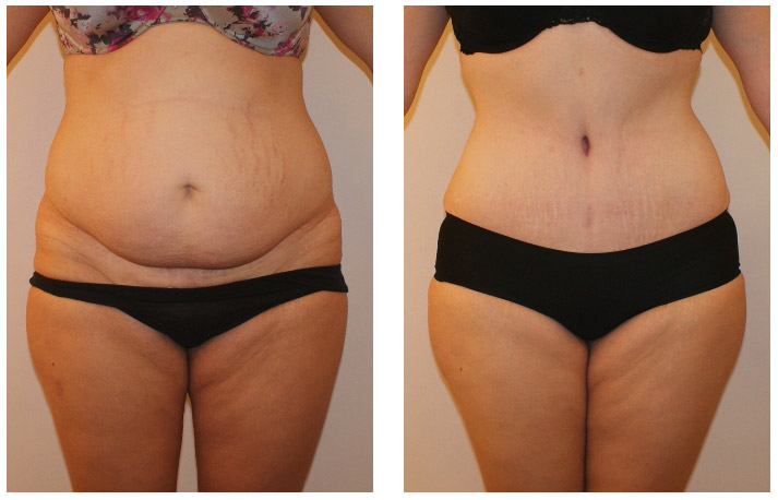 New York City Liposuction