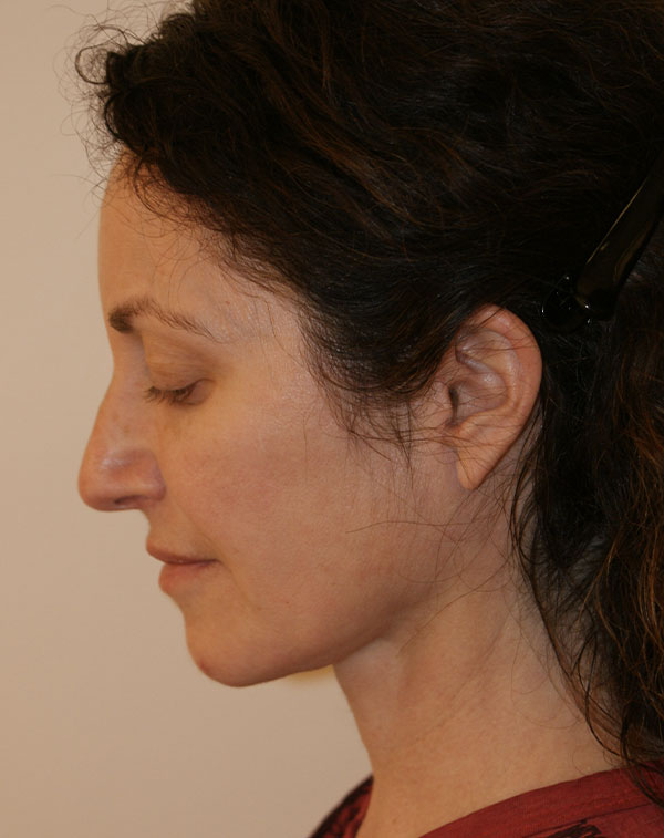 Photo of Patient 01 After Brow & Eyes Procedure