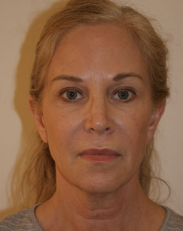 Photo of Patient 03 Before Brow & Eyes Procedure