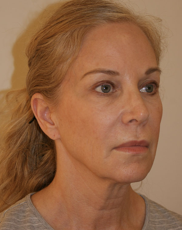 Photo of Patient 03 Before Brow & Eyes Procedure