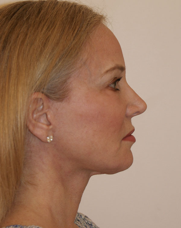 Photo of Patient 03 After Brow & Eyes Procedure