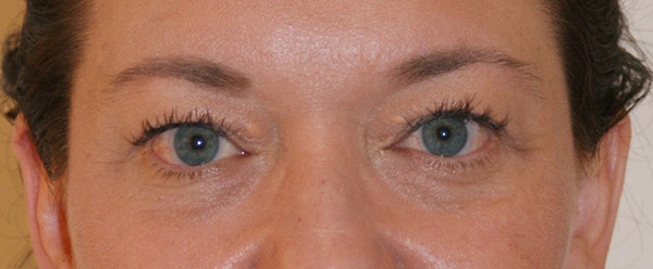 Photo of Patient 04 Before Brow & Eyes Procedure