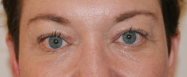 Photo of Patient 04 After Brow & Eyes Procedure