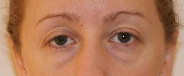 Photo of Patient 05 Before Brow & Eyes Procedure