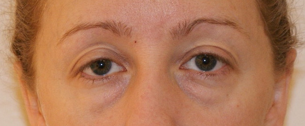 Brow & Eyes Before and After | Dino Elyassnia, MD