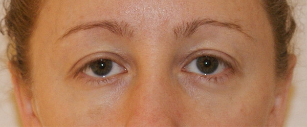 Photo of Patient 05 After Brow & Eyes Procedure