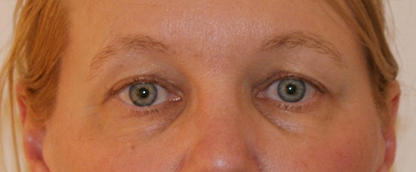 Photo of Patient 06 Before Brow & Eyes Procedure