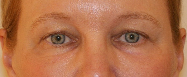 Photo of Patient 06 After Brow & Eyes Procedure