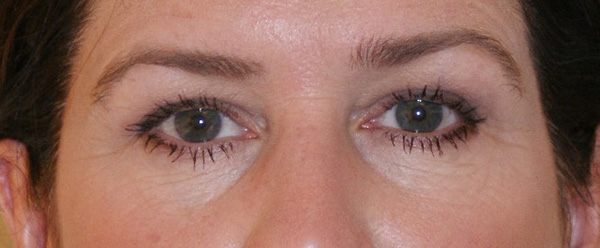 Photo of Patient 07 Before Brow & Eyes Procedure