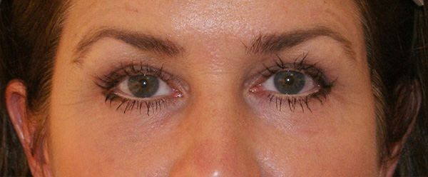 Photo of Patient 07 After Brow & Eyes Procedure