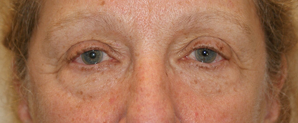 Photo of Patient 08 Before Brow & Eyes Procedure
