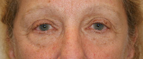 Brow & Eyes Before and After | Dino Elyassnia, MD