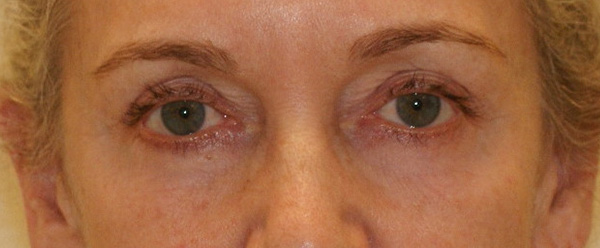 Photo of Patient 10 Before Brow & Eyes Procedure