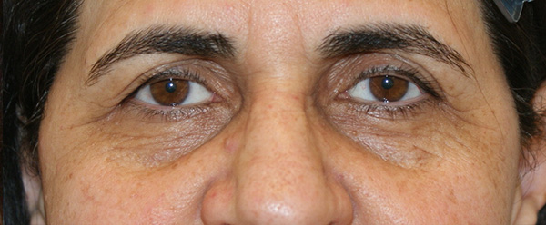 Photo of Patient 10 Before Brow & Eyes Procedure