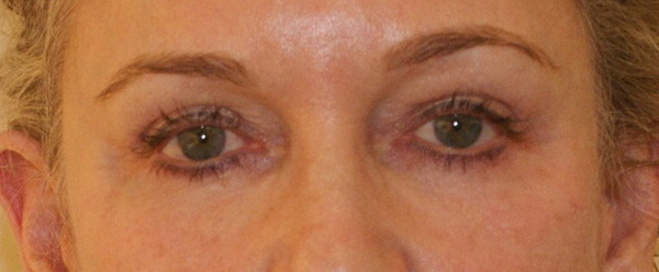 Photo of Patient 10 After Brow & Eyes Procedure