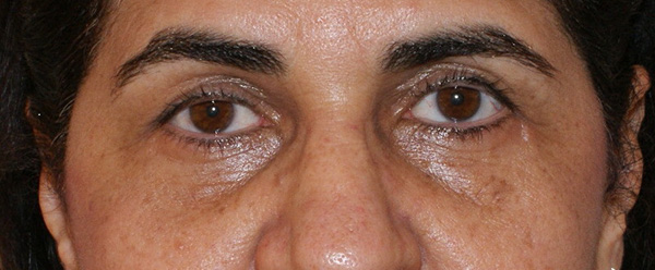 Photo of Patient 10 After Brow & Eyes Procedure