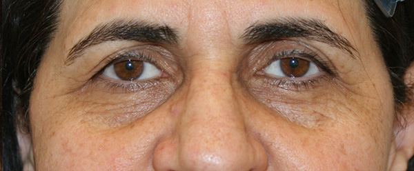 Photo of Patient 11 Before Brow & Eyes Procedure