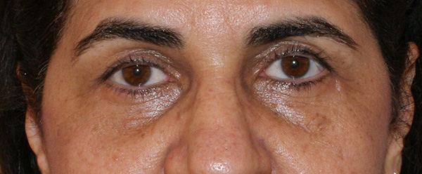 Brow & Eyes Gallery Patient 11