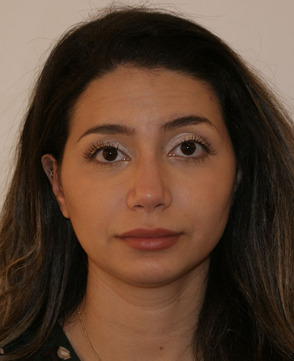 Photo of Patient 03 After Chin Implants Procedure
