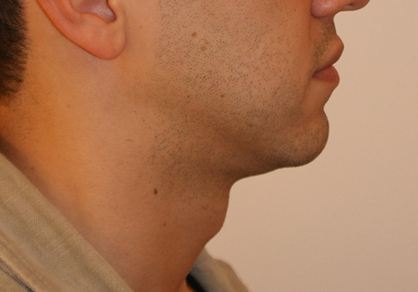 Photo of Patient 05 Before Chin Implants Procedure
