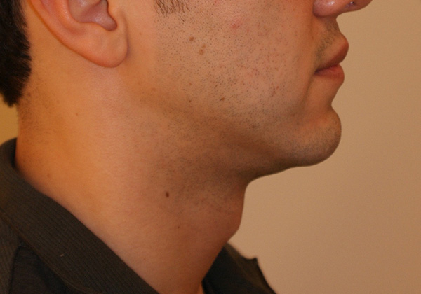 Photo of Patient 05 After Chin Implants Procedure