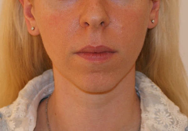 Photo of Patient 06 Before Chin Implants Procedure