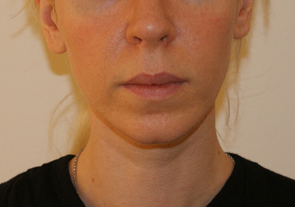 Photo of Patient 06 After Chin Implants Procedure