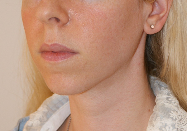 Photo of Patient 06 Before Chin Implants Procedure