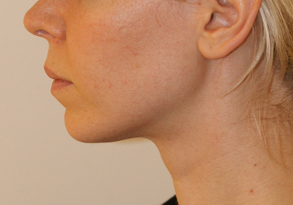 Photo of Patient 06 After Chin Implants Procedure