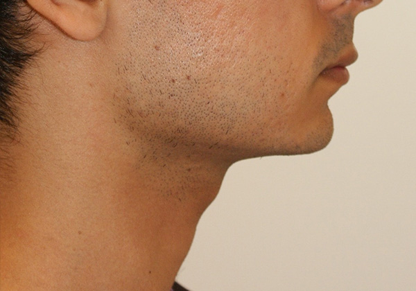 Photo of Patient 07 Before Chin Implants Procedure