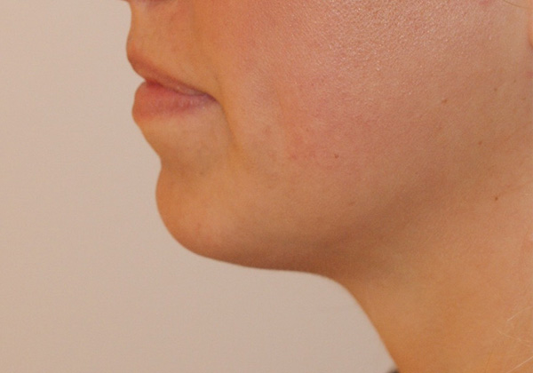 Photo of Patient 08 After Chin Implants Procedure