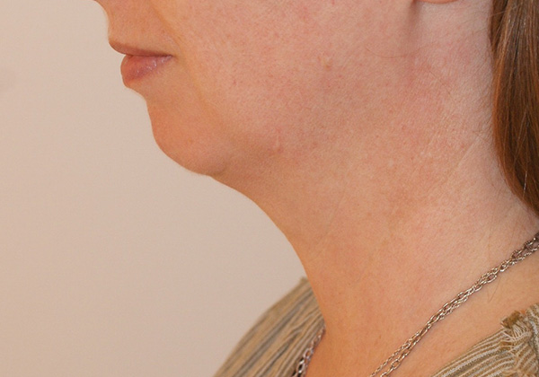 Photo of Patient 09 Before Chin Implants Procedure