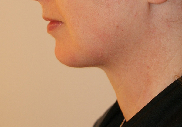 Chin Implants Gallery Patient 9
