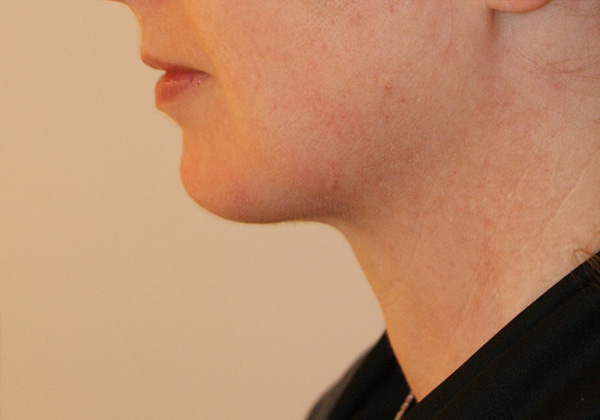 Photo of Patient 09 After Chin Implants Procedure