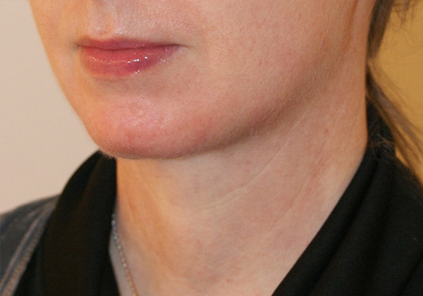 Photo of Patient 09 After Chin Implants Procedure