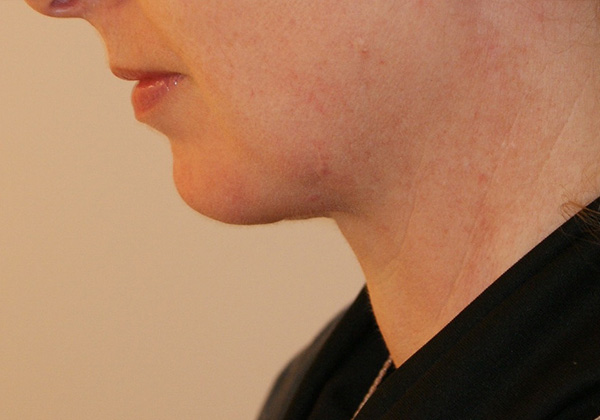 Photo of Patient 09 Before Chin Implants Procedure
