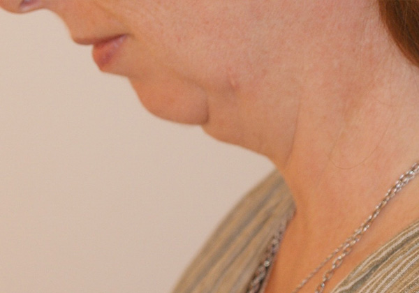 Photo of Patient 09 After Chin Implants Procedure