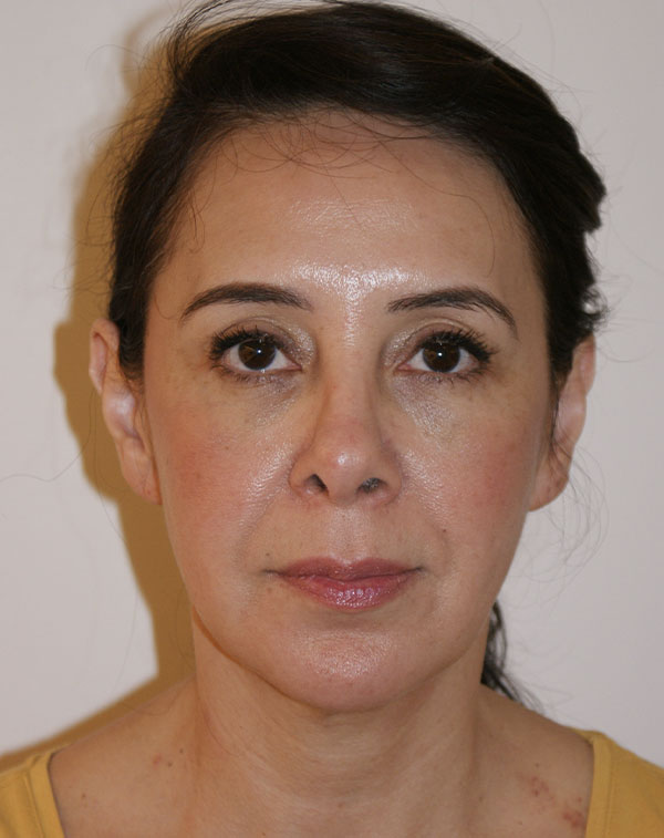 Face And Neck Lift Before and After | Dino Elyassnia, MD