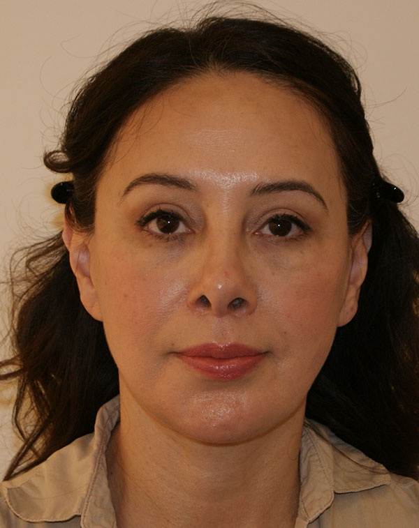 Face And Neck Lift Gallery Patient 1