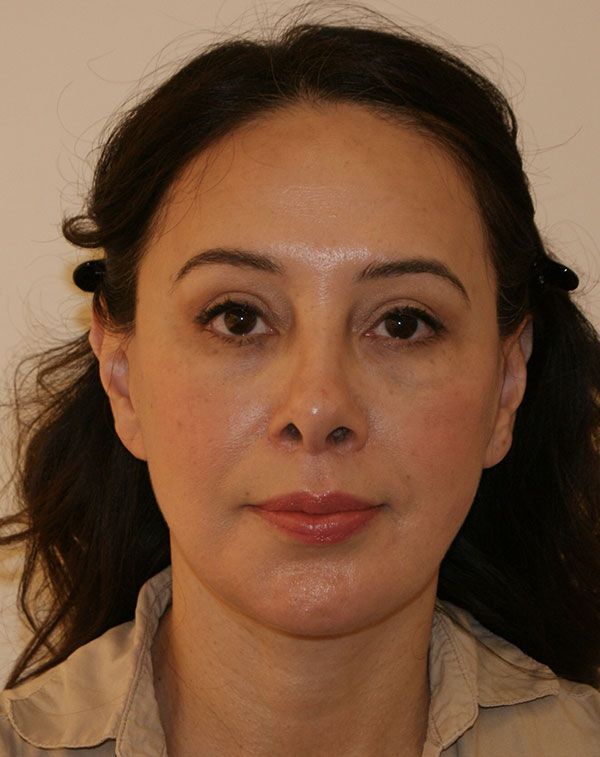 Photo of Patient 01 After Face And Neck Lift Procedure